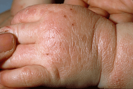 Atopic dermatitis symptoms